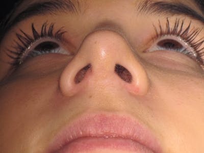 Rhinoplasty Before & After Gallery - Patient 4890995 - Image 8