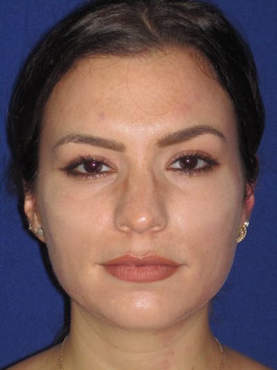 Rhinoplasty Before & After Gallery - Patient 4890999 - Image 1