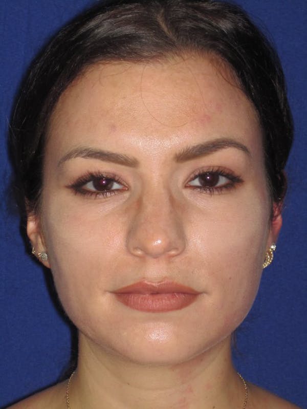 Rhinoplasty Before & After Gallery - Patient 4890999 - Image 1