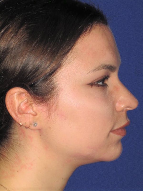 Rhinoplasty Before & After Gallery - Patient 4890999 - Image 3