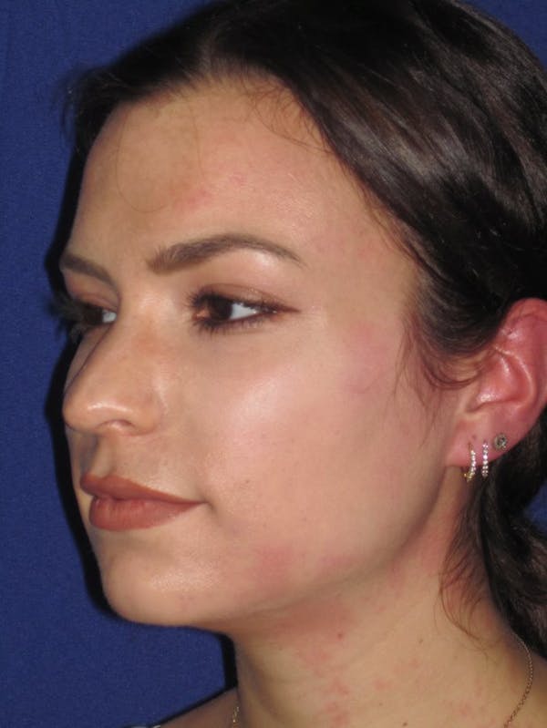 Rhinoplasty Before & After Gallery - Patient 4890999 - Image 5