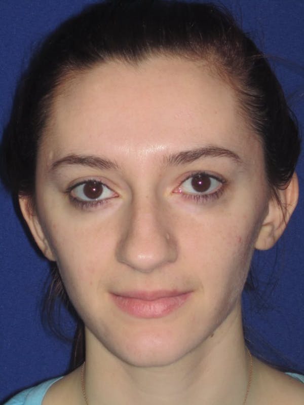 Rhinoplasty Before & After Gallery - Patient 4891004 - Image 1