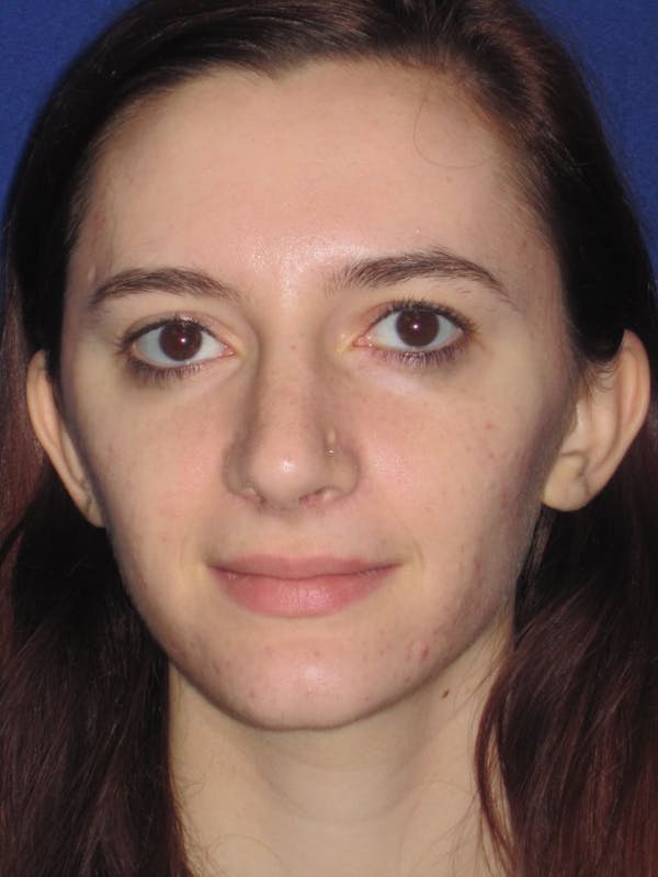 Rhinoplasty Gallery - Patient 4891004 - Image 2
