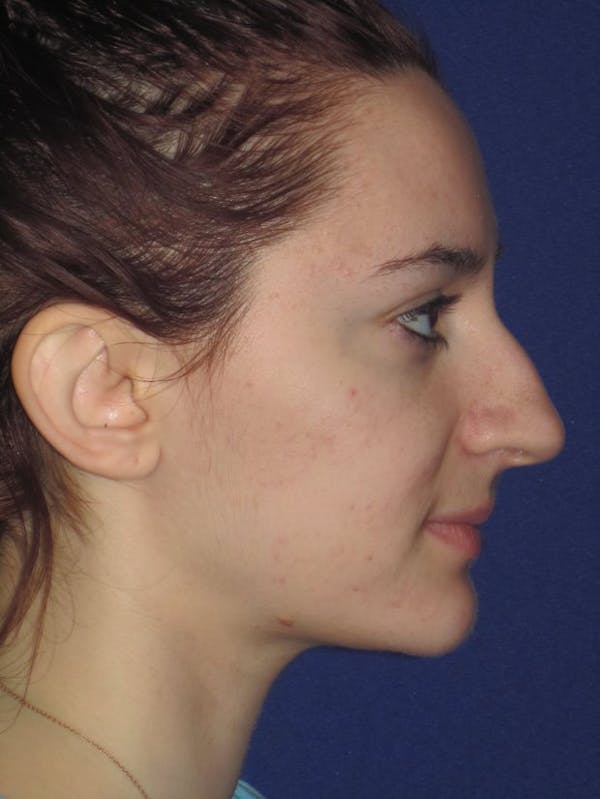 Rhinoplasty Before & After Gallery - Patient 4891004 - Image 3