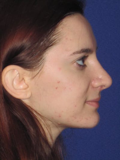 Rhinoplasty Before & After Gallery - Patient 4891004 - Image 4