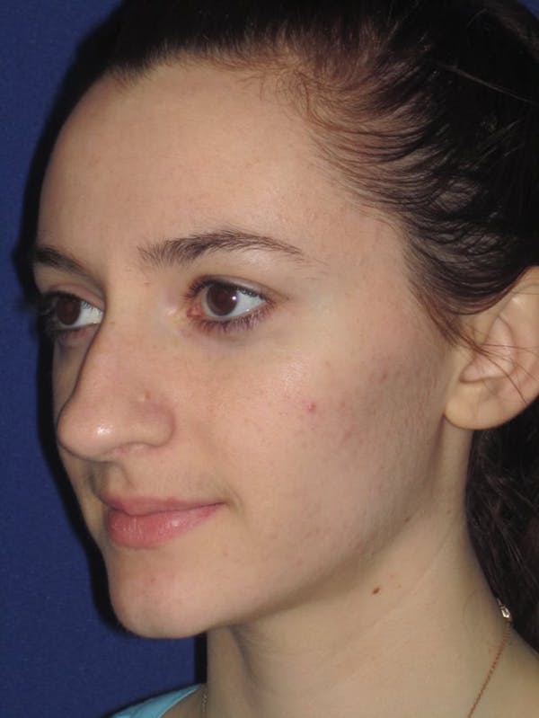 Rhinoplasty Before & After Gallery - Patient 4891004 - Image 5