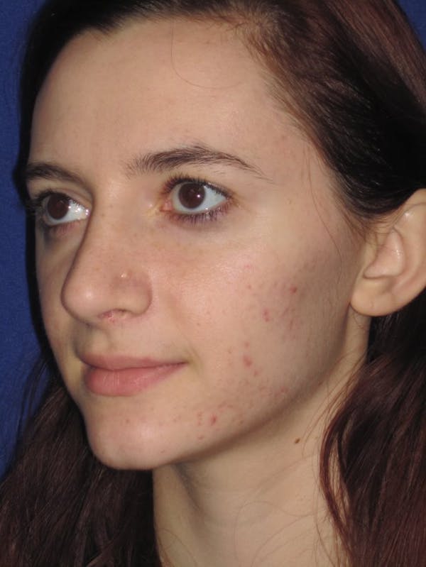 Rhinoplasty Before & After Gallery - Patient 4891004 - Image 6