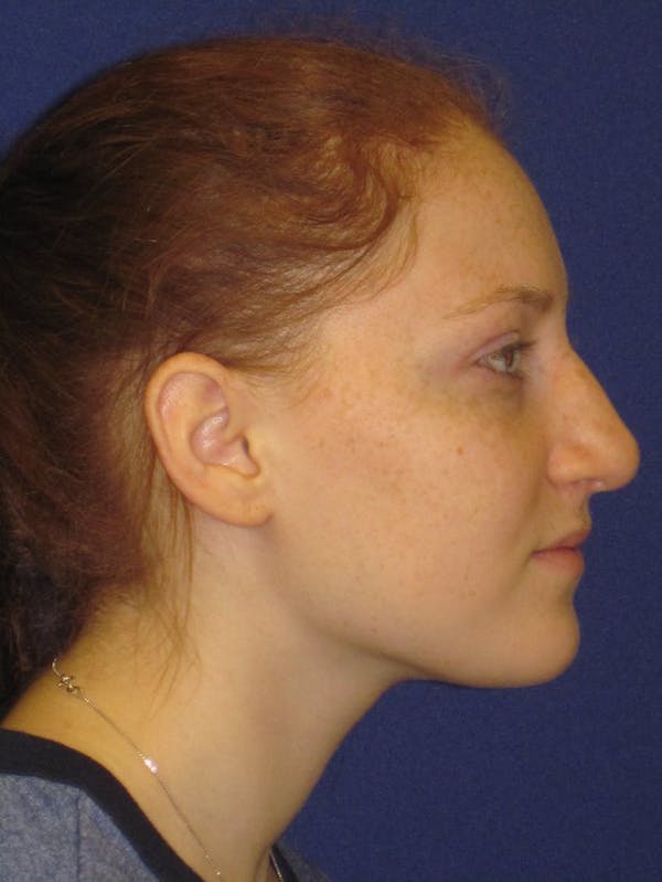 Rhinoplasty Before & After Gallery - Patient 4891006 - Image 3