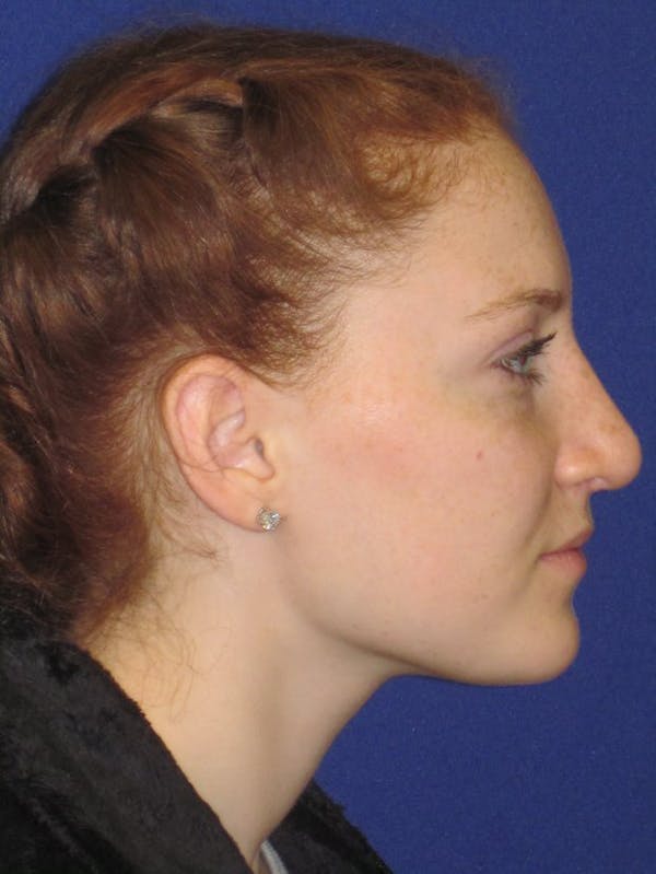 Rhinoplasty Before & After Gallery - Patient 4891006 - Image 4