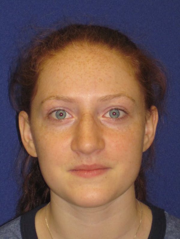 Rhinoplasty Before & After Gallery - Patient 4891006 - Image 5