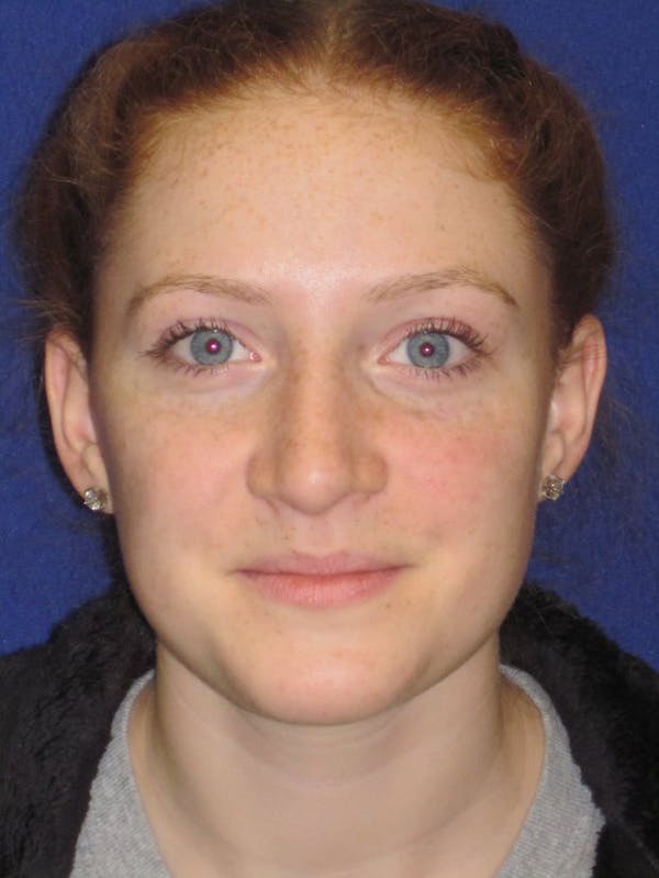 Rhinoplasty Gallery - Patient 4891006 - Image 6
