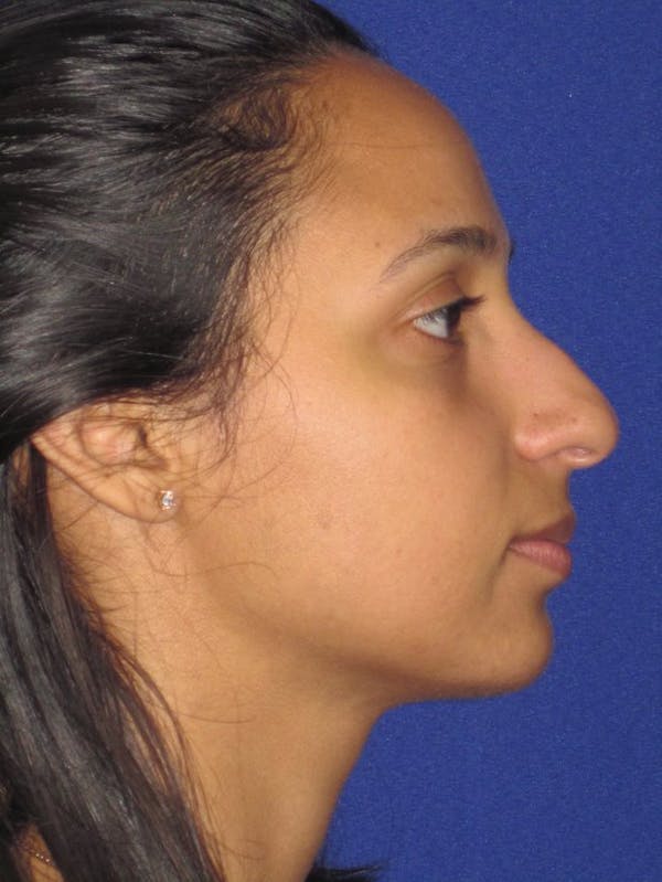Rhinoplasty Before & After Gallery - Patient 4891009 - Image 3