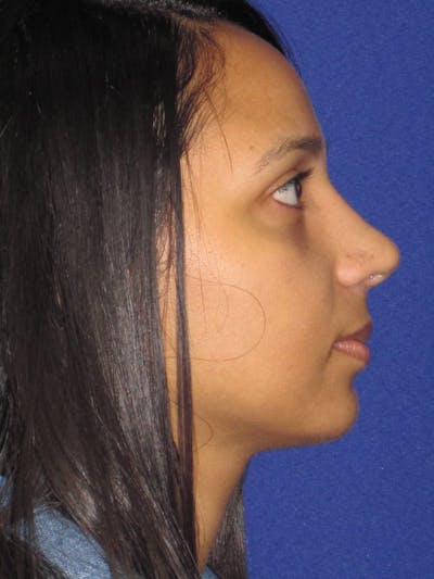 Rhinoplasty Before & After Gallery - Patient 4891009 - Image 4
