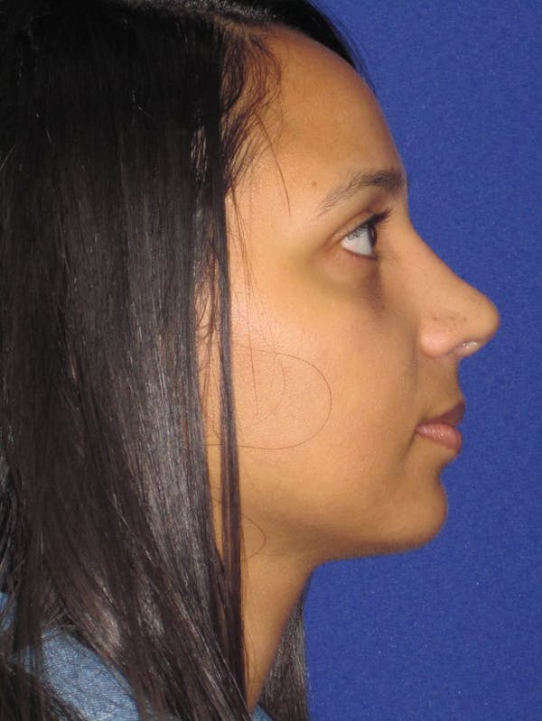 Rhinoplasty Before & After Gallery - Patient 4891009 - Image 4