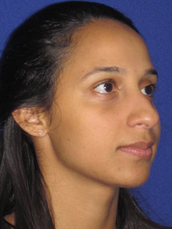 Rhinoplasty Before & After Gallery - Patient 4891009 - Image 5