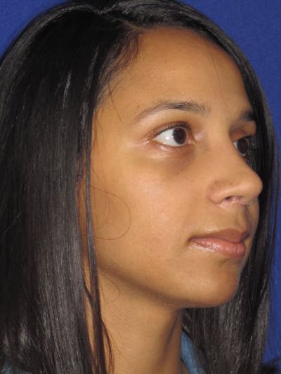 Rhinoplasty Before & After Gallery - Patient 4891009 - Image 6