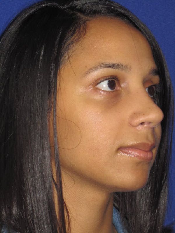 Rhinoplasty Before & After Gallery - Patient 4891009 - Image 6