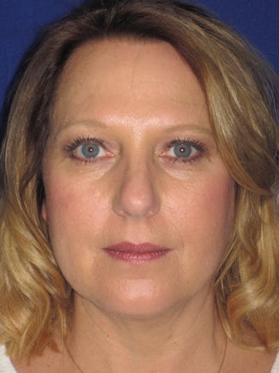 Rhinoplasty Before & After Gallery - Patient 4891016 - Image 1