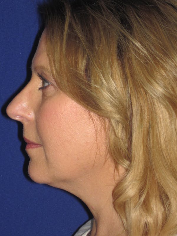 Rhinoplasty Before & After Gallery - Patient 4891016 - Image 5