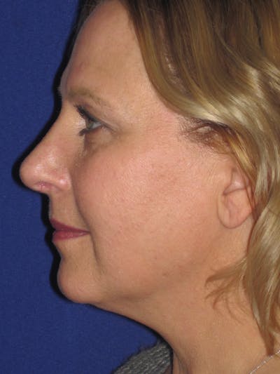 Rhinoplasty Before & After Gallery - Patient 4891016 - Image 6