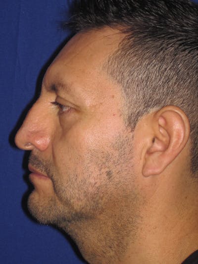 Rhinoplasty Before & After Gallery - Patient 4891025 - Image 1