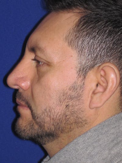 Rhinoplasty Before & After Gallery - Patient 4891025 - Image 2