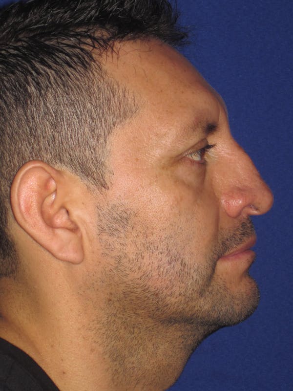 Rhinoplasty Before & After Gallery - Patient 4891025 - Image 3