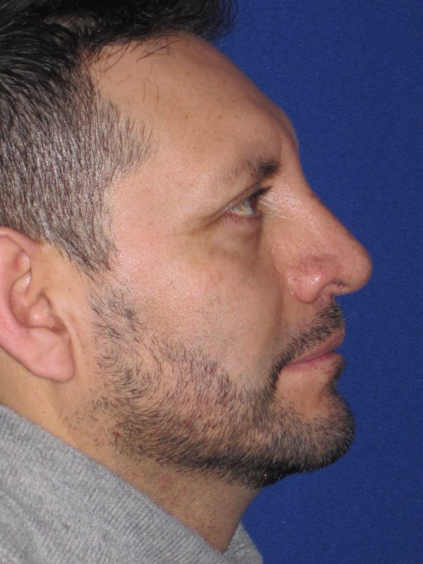 Rhinoplasty Before & After Gallery - Patient 4891025 - Image 4