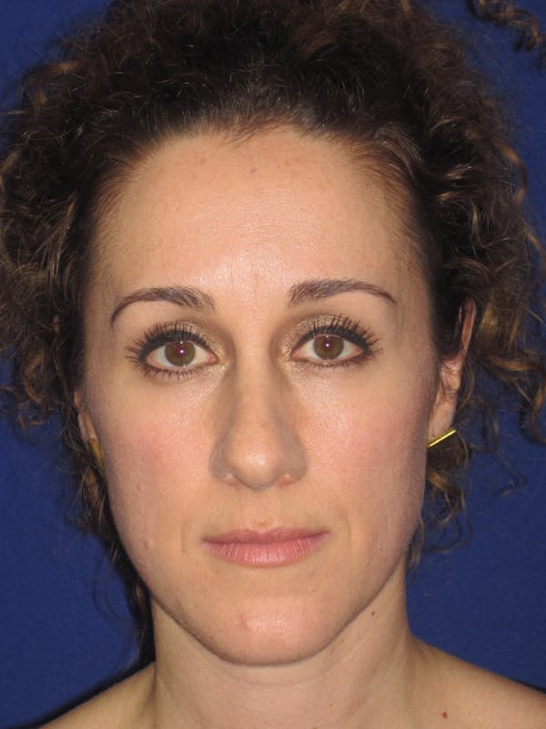 Rhinoplasty Before & After Gallery - Patient 4891034 - Image 1