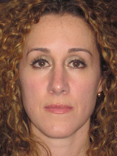 Rhinoplasty Before & After Gallery - Patient 4891034 - Image 2