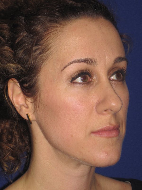 Rhinoplasty Before & After Gallery - Patient 4891034 - Image 3