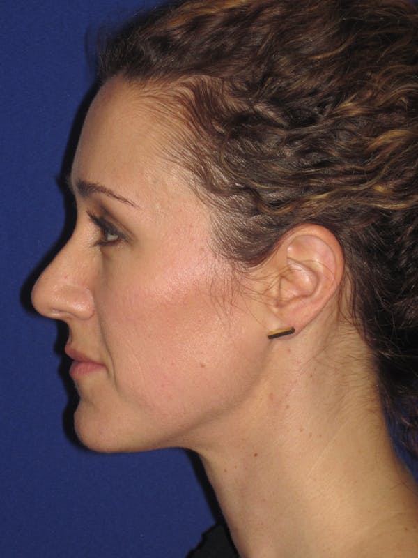 Rhinoplasty Before & After Gallery - Patient 4891034 - Image 5