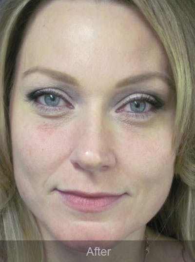 Botox Before & After Gallery - Patient 4891032 - Image 2