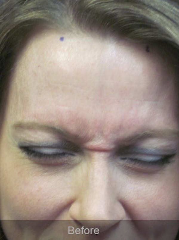 Botox Before & After Gallery - Patient 4891032 - Image 3