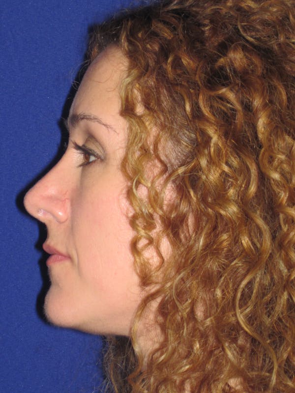 Rhinoplasty Before & After Gallery - Patient 4891034 - Image 6
