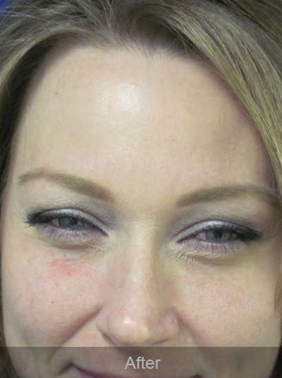 Botox Before & After Gallery - Patient 4891032 - Image 4