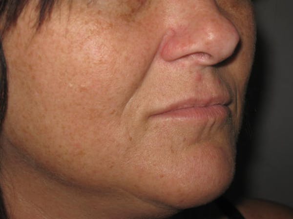 Laser Skin Resurfacing Before & After Gallery - Patient 4891036 - Image 1