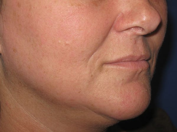 Laser Skin Resurfacing Before & After Gallery - Patient 4891036 - Image 2