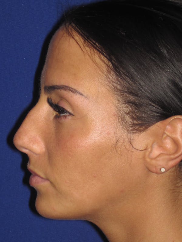 Rhinoplasty Before & After Gallery - Patient 4891044 - Image 1