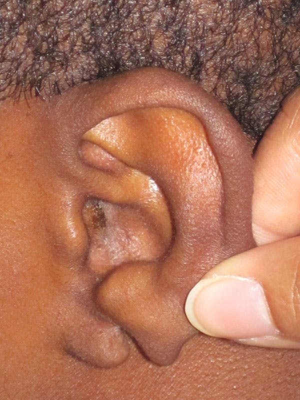 Split Ear Lobe Repair Before & After Gallery - Patient 4891038 - Image 1