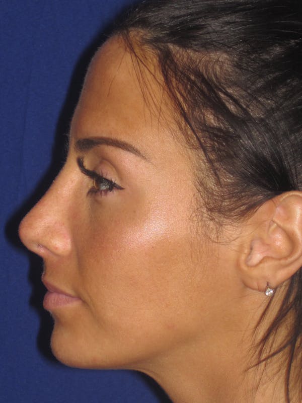 Rhinoplasty Before & After Gallery - Patient 4891044 - Image 2