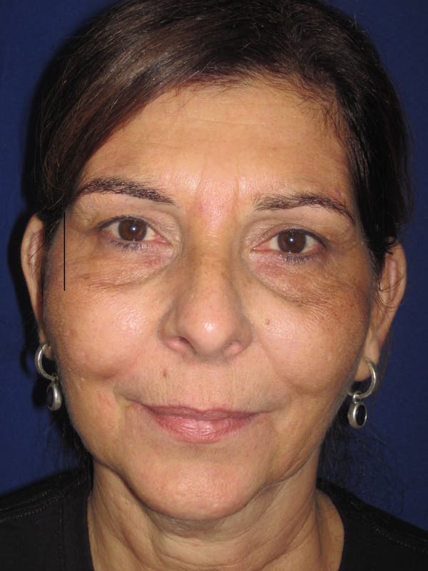 Laser Skin Resurfacing Before & After Gallery - Patient 4891046 - Image 1