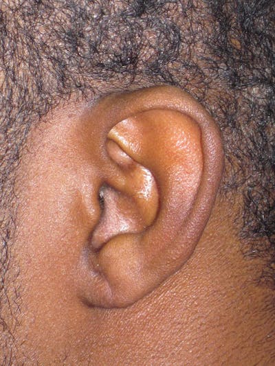 Split Ear Lobe Repair Before & After Gallery - Patient 4891038 - Image 2