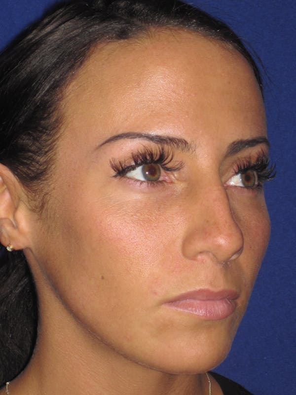 Rhinoplasty Before & After Gallery - Patient 4891044 - Image 3