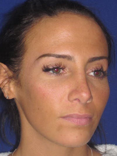 Rhinoplasty Before & After Gallery - Patient 4891044 - Image 4