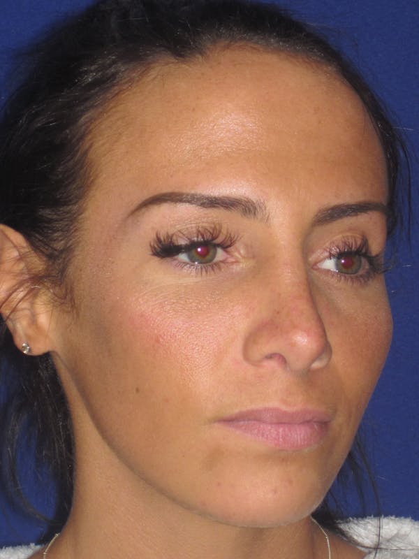 Rhinoplasty Before & After Gallery - Patient 4891044 - Image 4