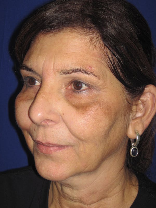Laser Skin Resurfacing Before & After Gallery - Patient 4891046 - Image 3