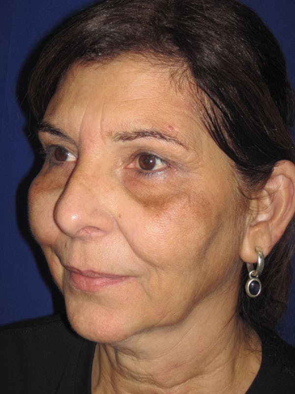Laser Skin Resurfacing Before & After Gallery - Patient 4891046 - Image 3