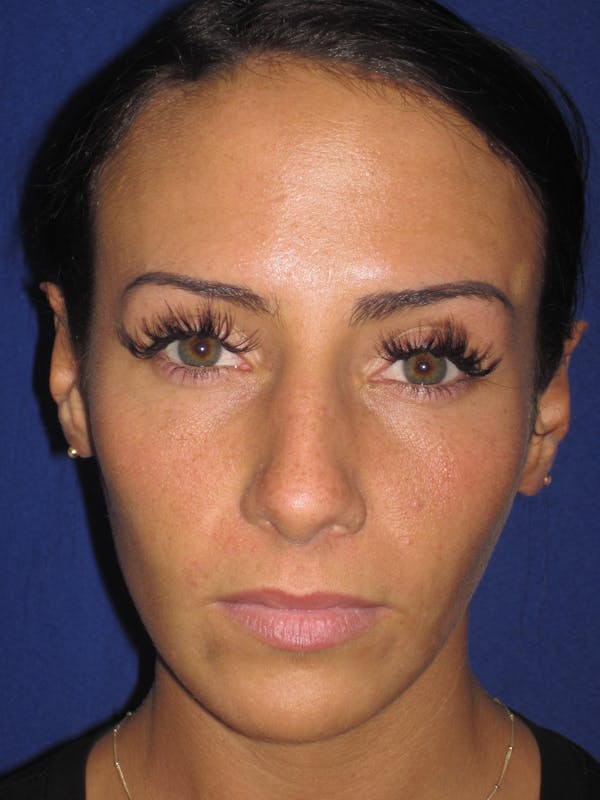 Rhinoplasty Before & After Gallery - Patient 4891044 - Image 5