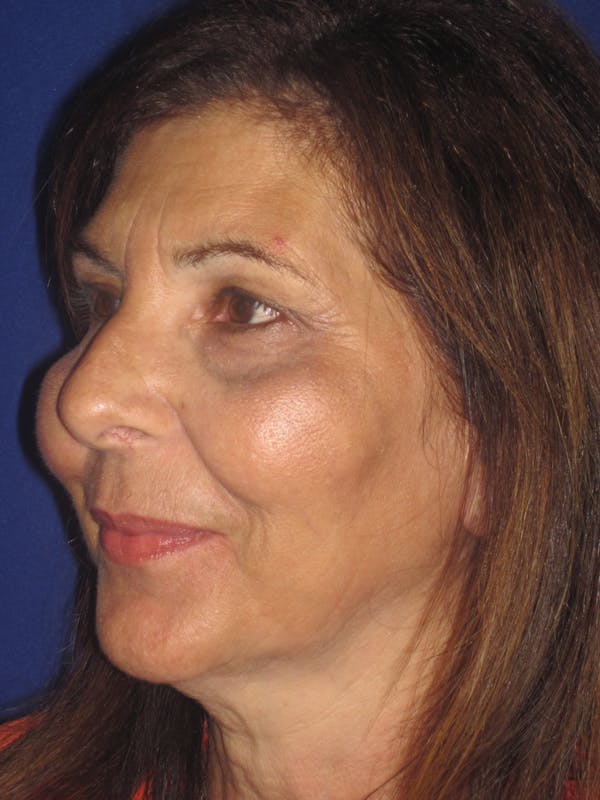 Laser Skin Resurfacing Before & After Gallery - Patient 4891046 - Image 4